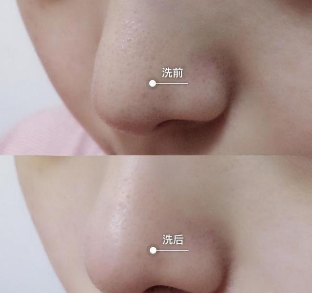 如何解決皮膚黑頭、閉口和毛孔粗大的問題？