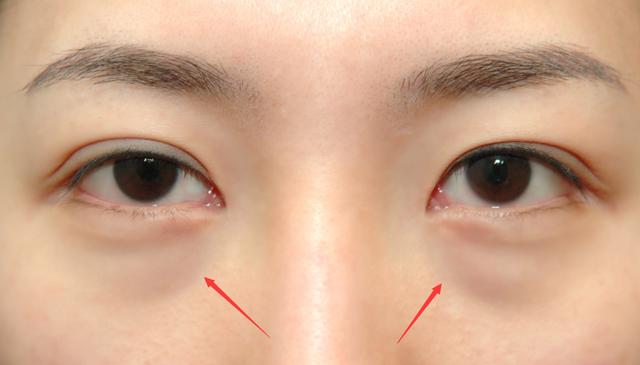 眼袋重、皮膚暗沉怎么辦？這些方法快收藏