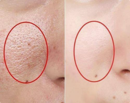 該怎么區分不同類型的黑頭呢？