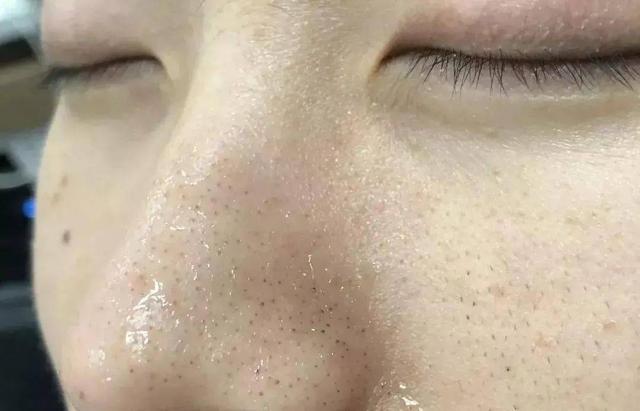 擠痘痘時冒出的白色物質是什么？