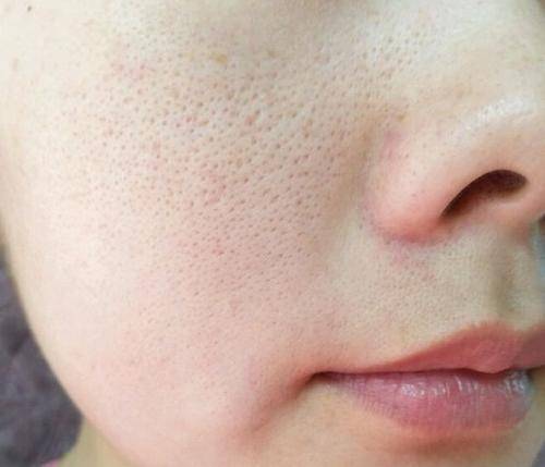 毛孔堵了，再好的護(hù)膚品都沒(méi)用