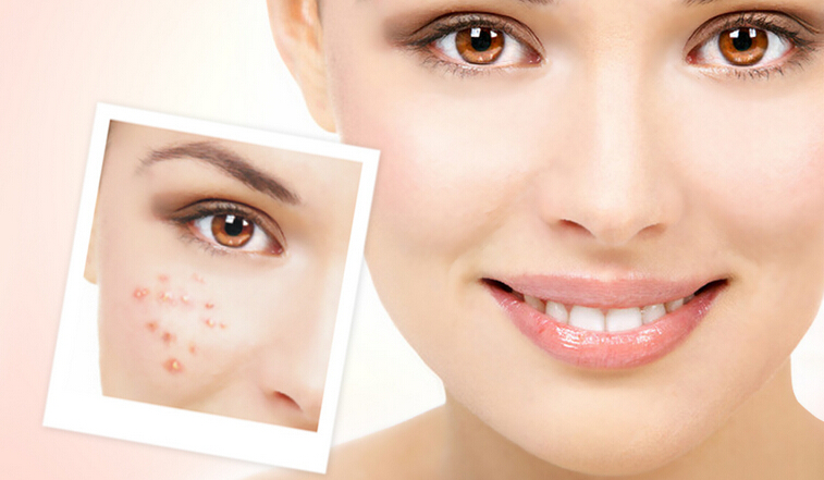 跟痘痘說拜拜！超實用的戰(zhàn)痘指南