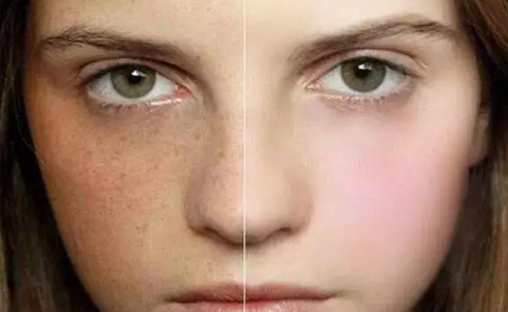 告別斑點(diǎn)困擾，科學(xué)祛斑讓肌膚重拾凈透光彩