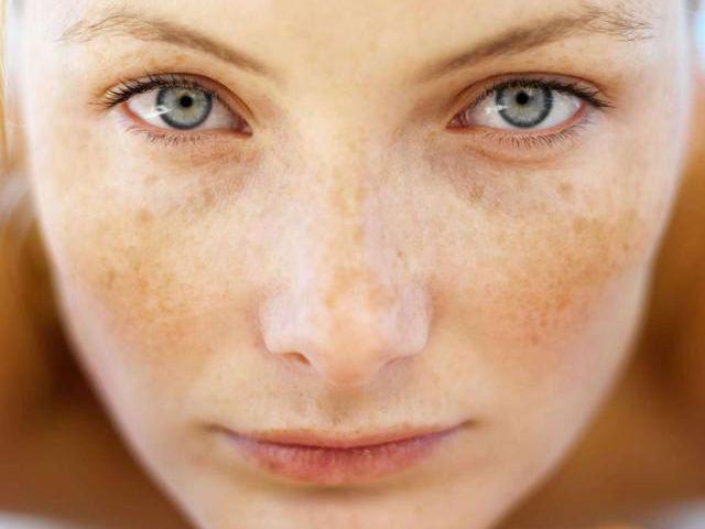 色斑突襲！肌膚“長斑”危機大揭秘與自救指南