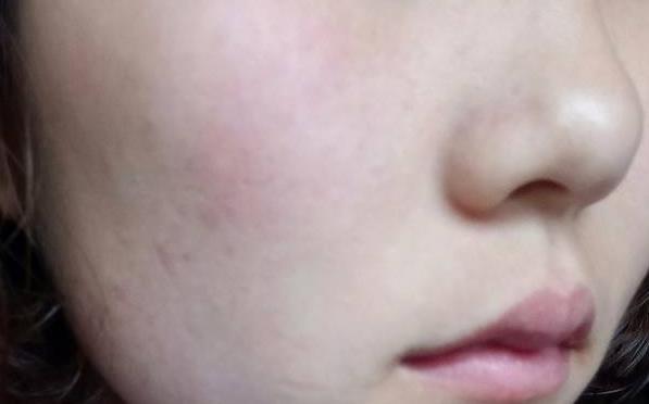 皮膚泛紅不用慌！教你快速分辨4大類泛紅