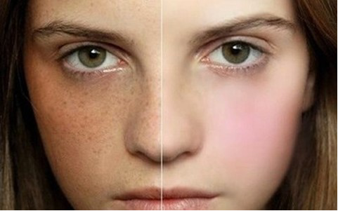 色斑的“前世今生”與科學(xué)淡化方案