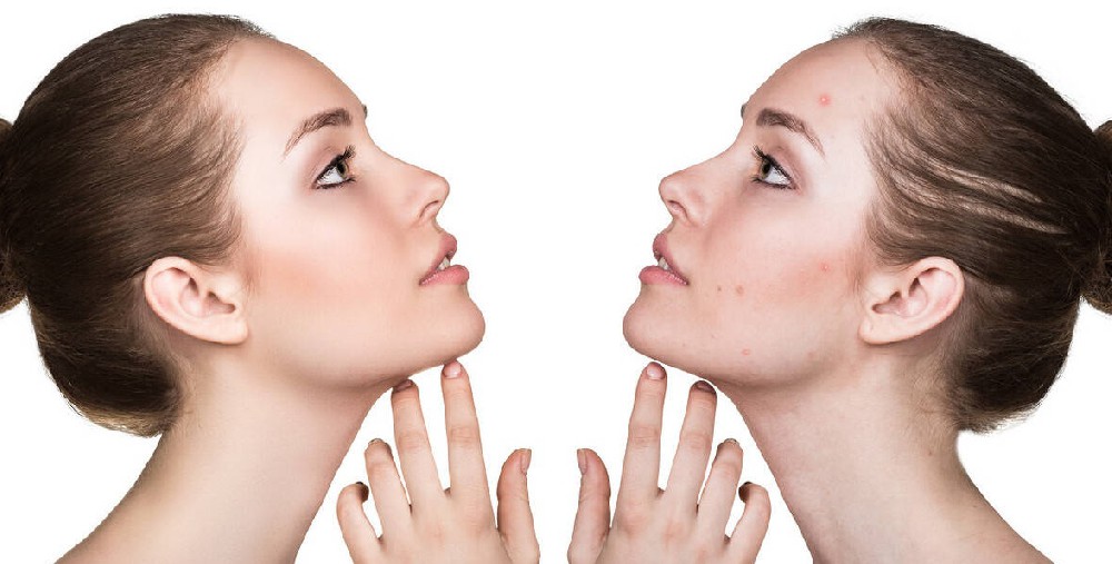 痘痘、閉口、粉刺大區分！教你精準對癥解決