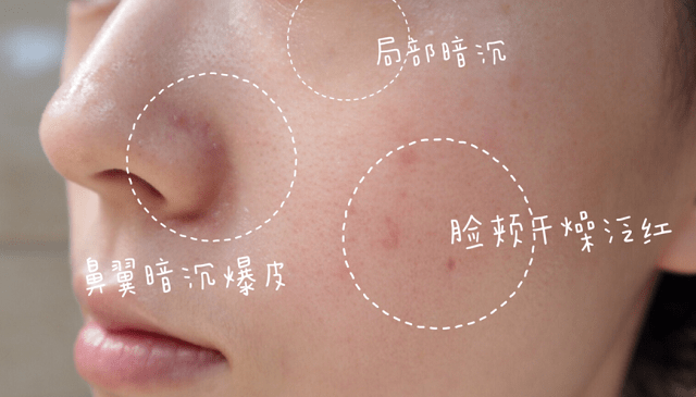 皮膚敏感的原因是什么？皮脂膜受損該如何補救？