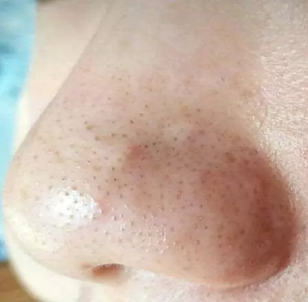 告別黑頭閉口粉刺，解鎖通透“零毛孔”肌